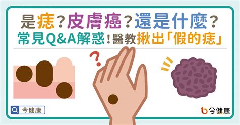 雞雞痣很多|是痣？皮膚癌？還是什麼？常見Q&A解惑！醫教揪出「假的痣」